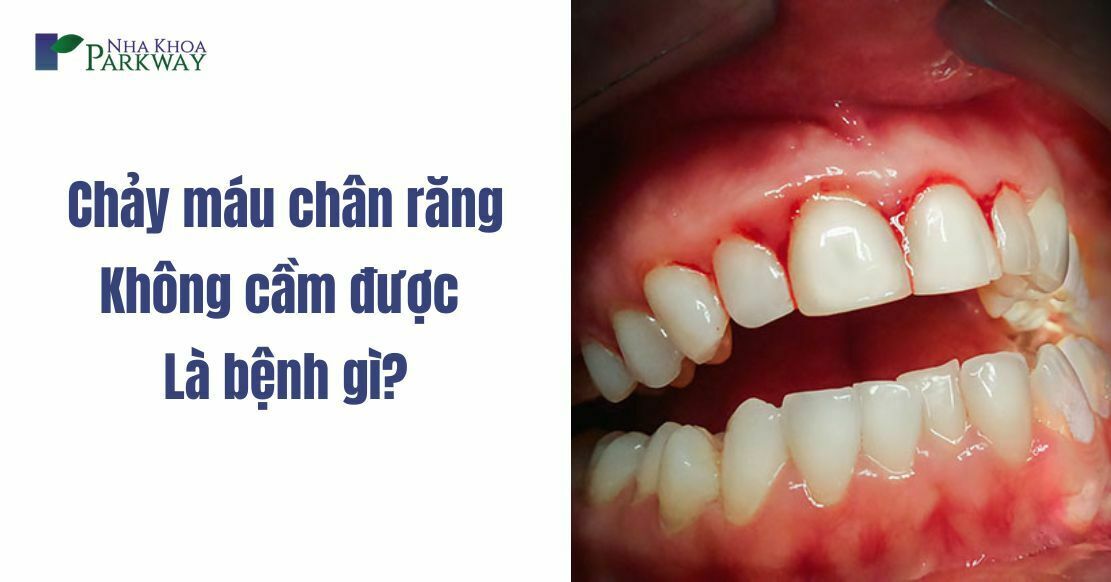 Chảy máu chân răng không cầm được là bệnh gì? Nguyên nhân do đâu?