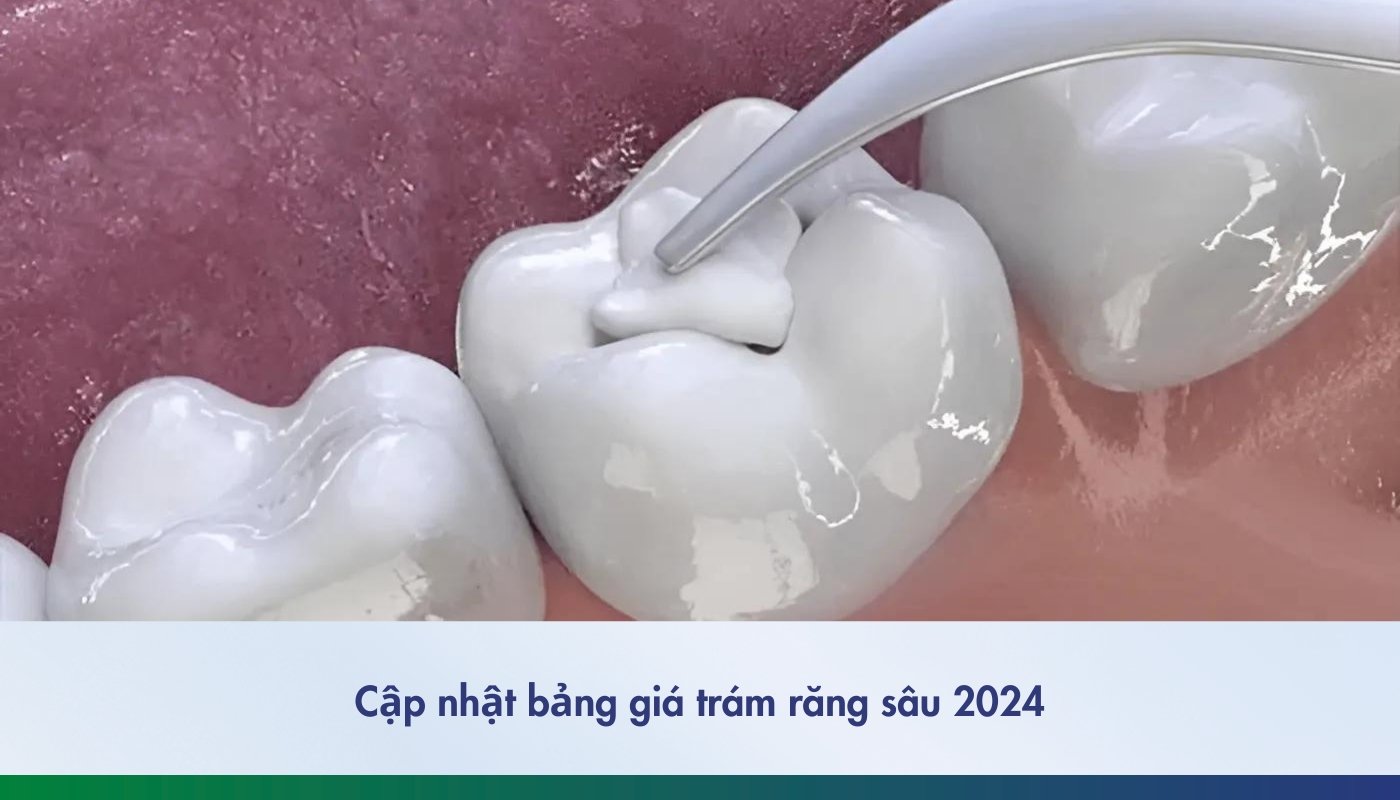 Cập nhật bảng giá trám răng sâu 2024