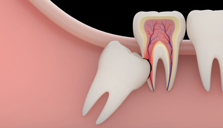 Hình ảnh răng khôn mọc đâm vào răng số 7