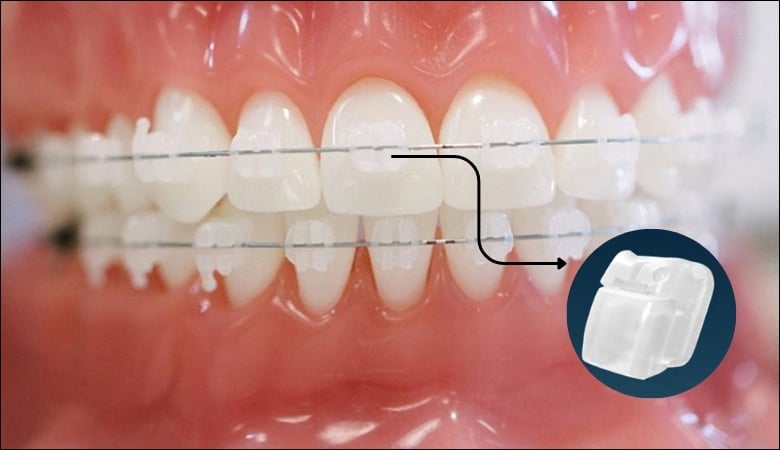 Niềng răng mắc cài pha lê - 3