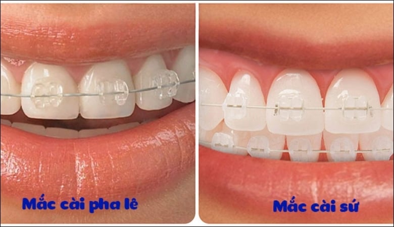 Niềng răng mắc cài pha lê - 6