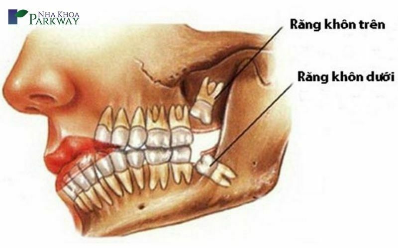 Quá trình mọc răng khôn không diễn ra liên tục như nhiều người lầm tưởng