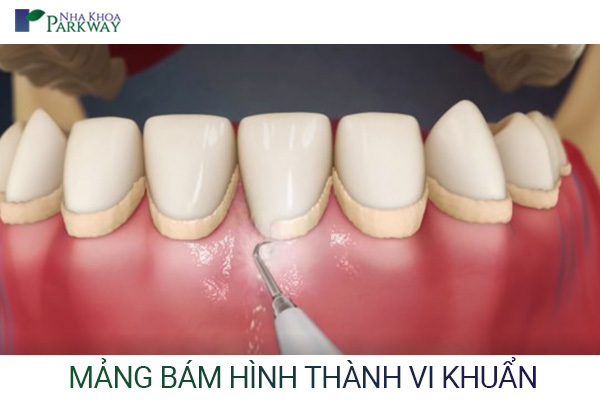 voi rang