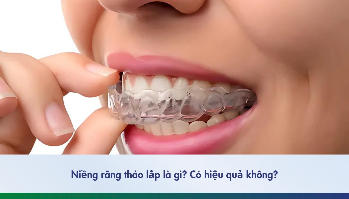 niềng răng tháo lắp là gì