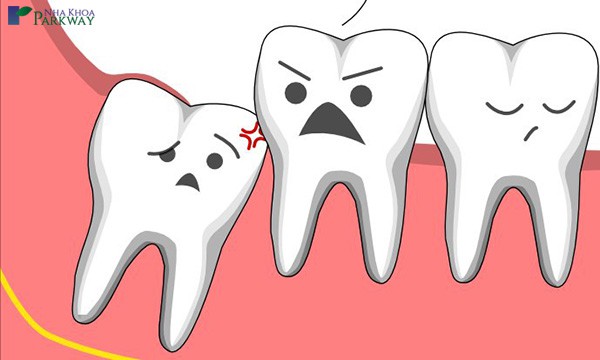 cách giảm đau răng khôn