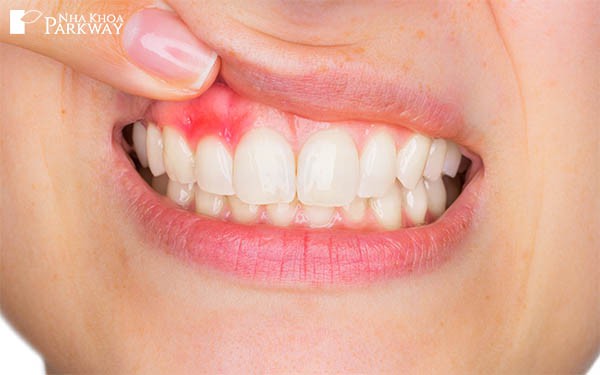 Niềng răng trong suốt giá rẻ kém chất lượng có thể gây ra viêm nướu nghiêm trọng