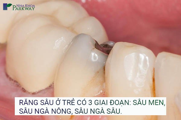 dấu hiệu răng sâu ở trẻ em