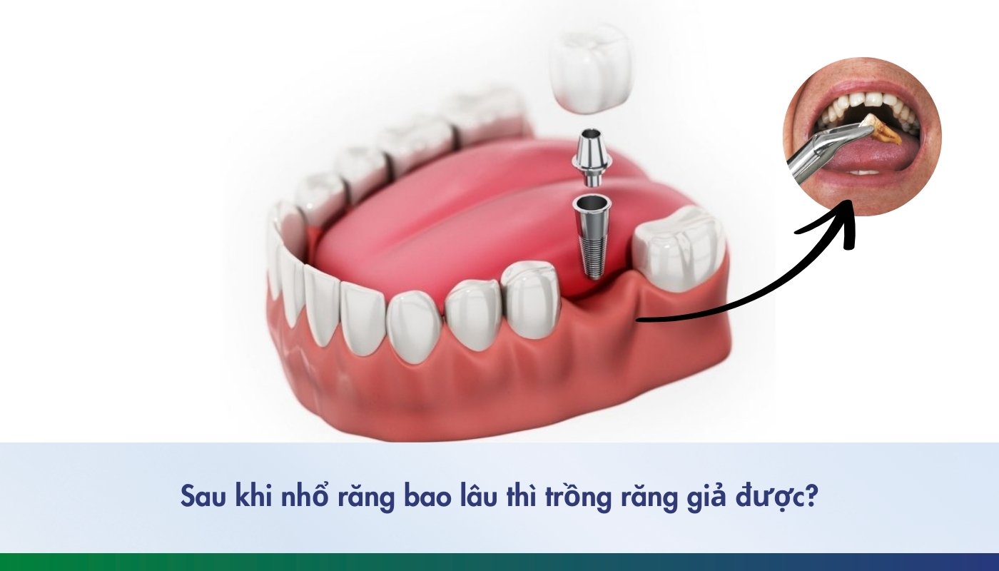 Sau khi nhổ răng bao lâu thì trồng răng giả được?