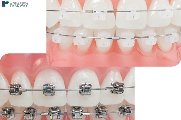 niềng răng mắc cài sứ