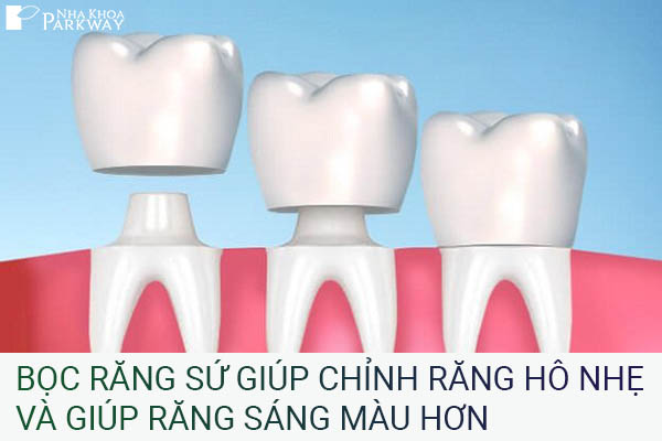chỉnh răng hô bằng cách bọc răng sứ