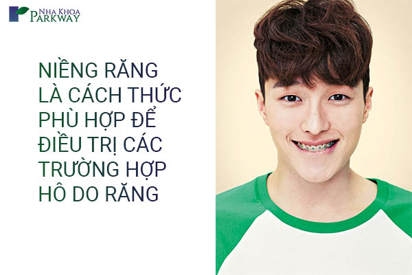 khi nào cần niềng răng để chỉnh răng hô?