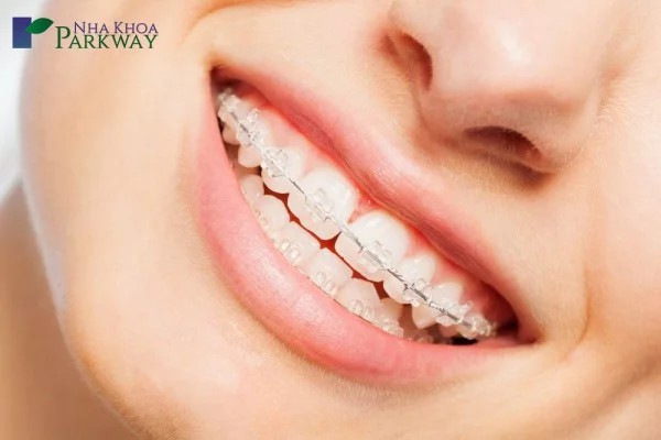 niềng răng mắc cài sứ