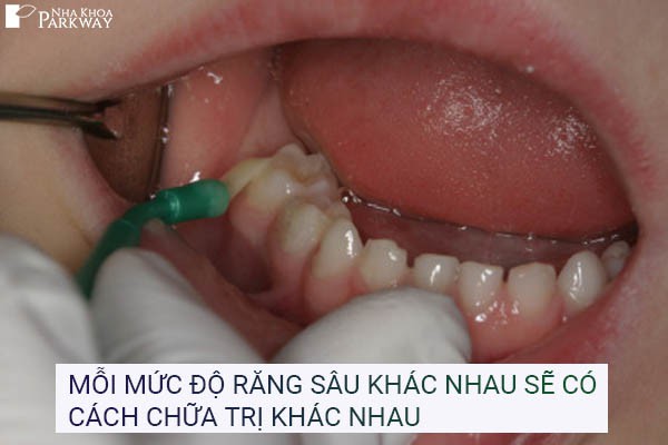 điều trị sâu răng ở trẻ em