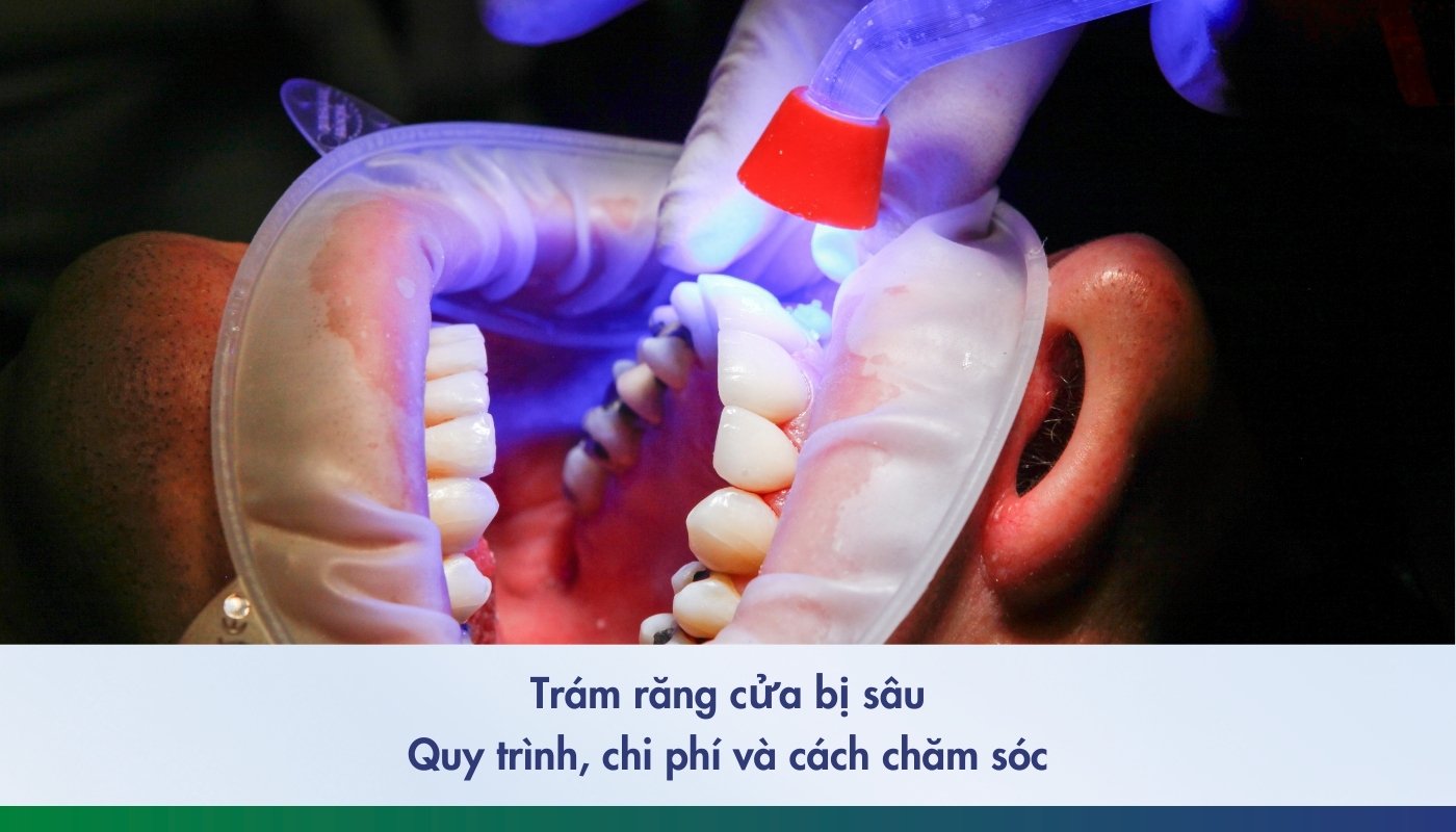 Trám răng cửa bị sâu: Quy trình, bảng giá và cách chăm sóc