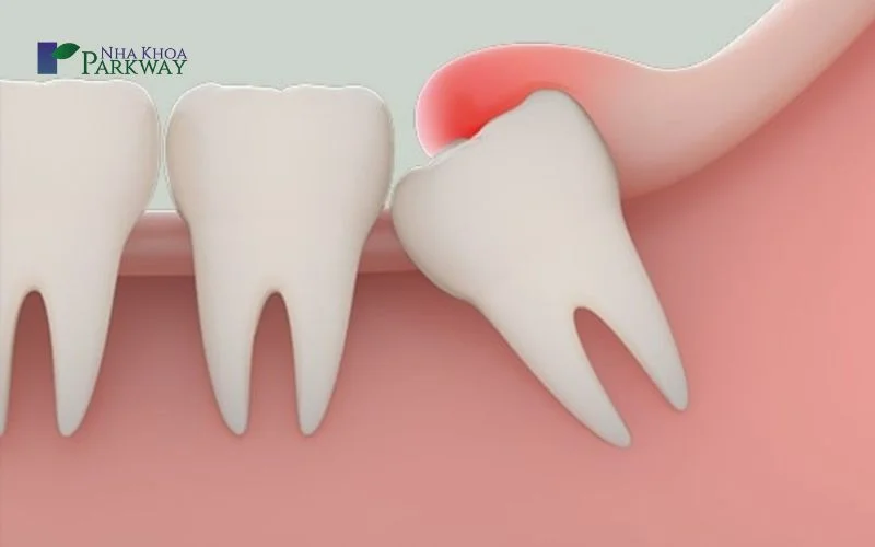 Nguyên nhân gây nhức răng?