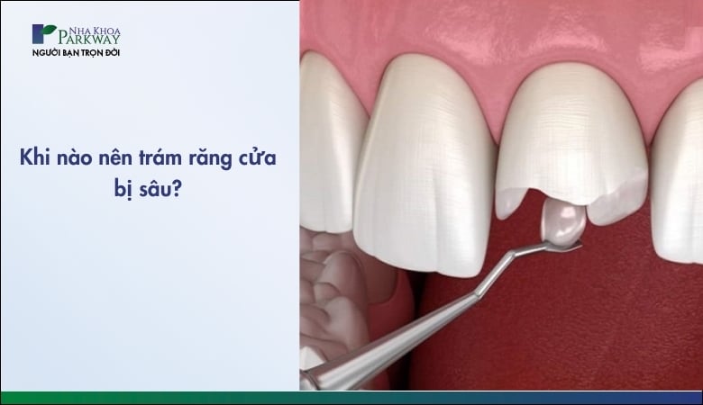 Trám răng cửa bị sâu - 1