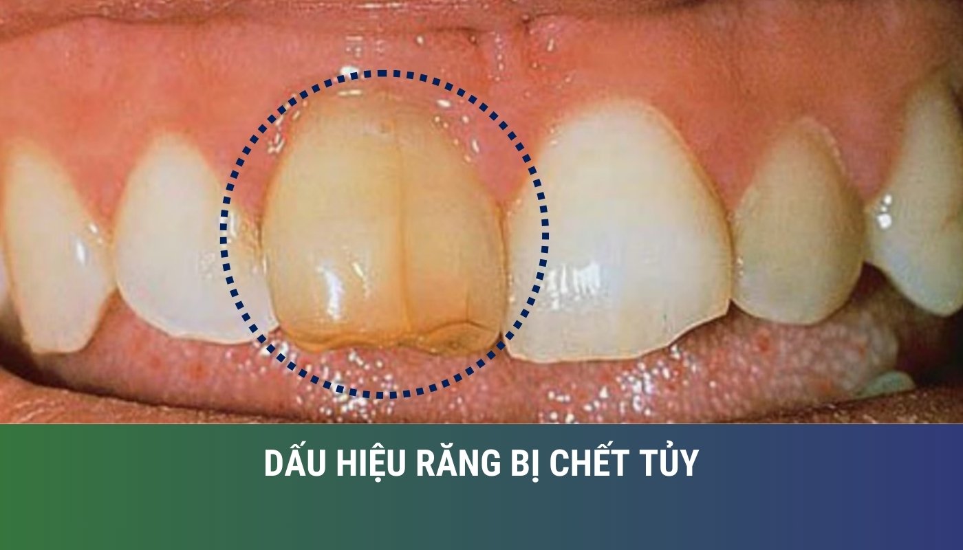 Dấu hiệu răng bị chết tủy và cách điều trị hiệu quả, an toàn