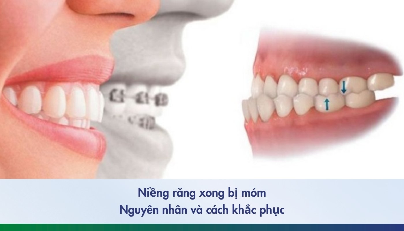 Niềng răng xong bị móm: Nguyên nhân và cách khắc phục