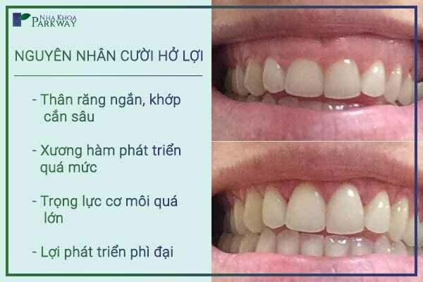 cười hở lợi