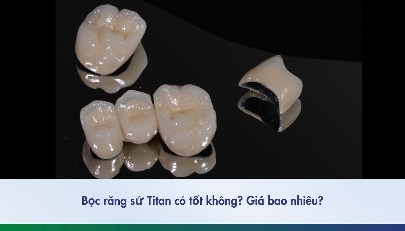 Bọc răng sứ Titan có tốt không? Giá bao nhiêu