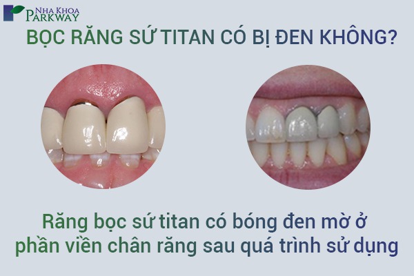 bọc răng sứ titan có bị đen không?