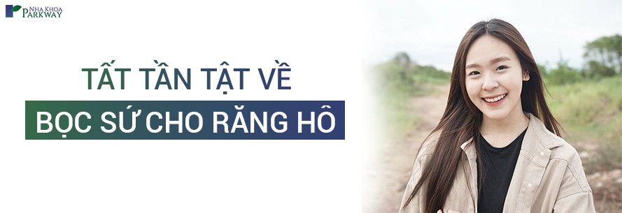 tất tần tật về bọc sứ cho răng hô