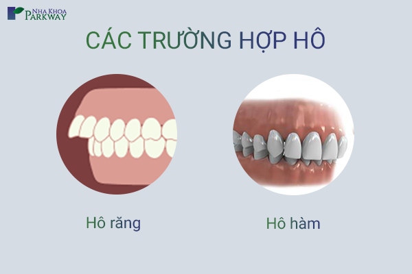 các trường hợp răng hô