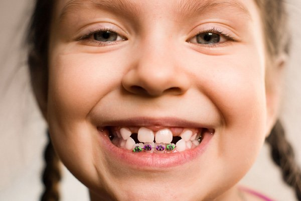 Bao nhiêu tuổi thì được niềng răng