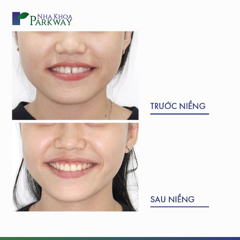 Khuôn mặt trước và sau khi niềng răng thưa
