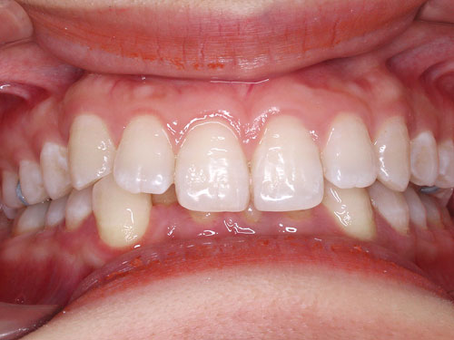 hình ảnh niềng răng cắn sâu