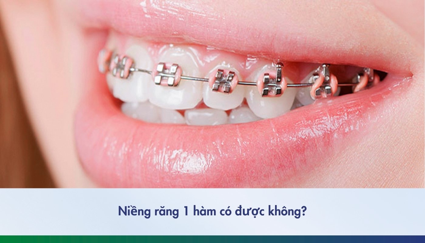 Niềng răng 1 hàm có được không? Giá bao nhiêu?