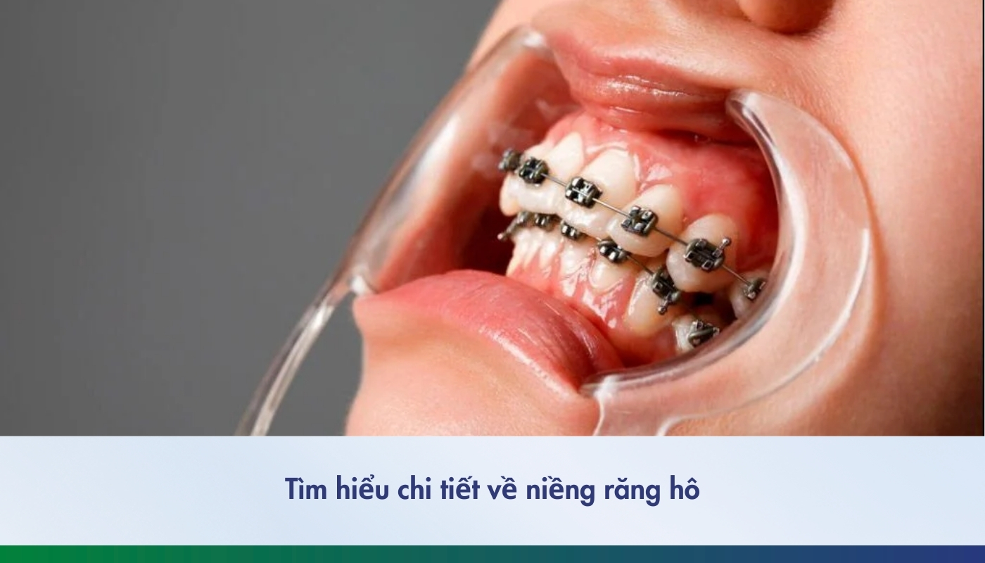 Niềng răng hô là gì? Trường hợp nào có thể niềng răng hô