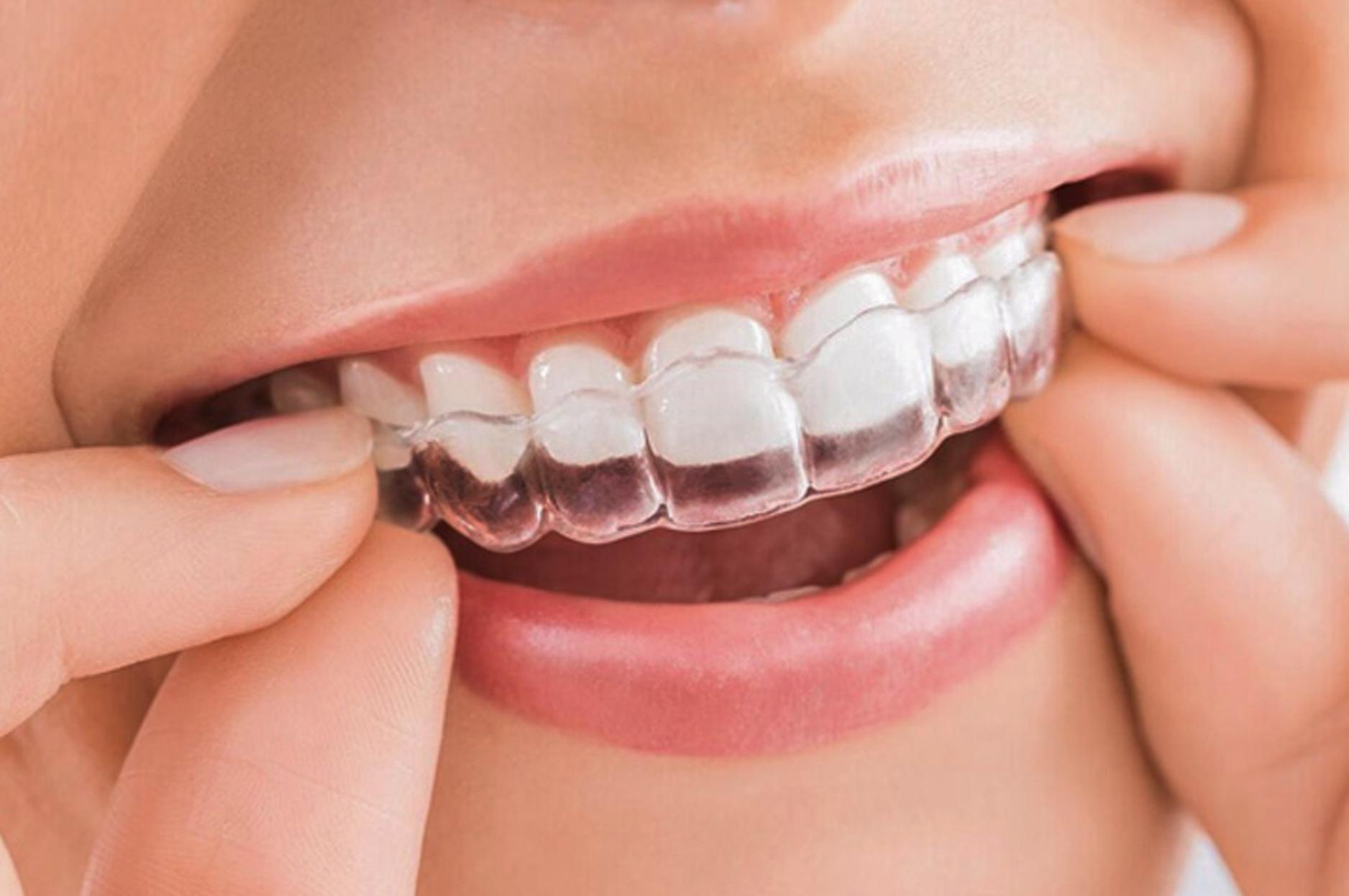 các phương pháp niềng răng một hàm