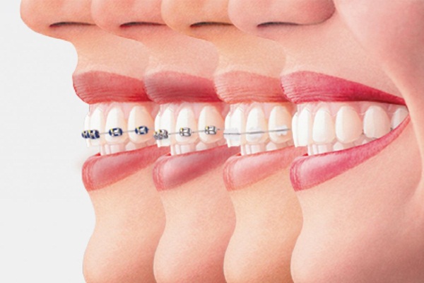 niềng răng 3 giai đoạn