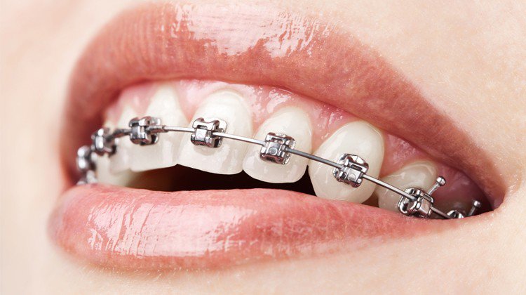 Niềng răng kim loại là gì? Quy trình và phân loại