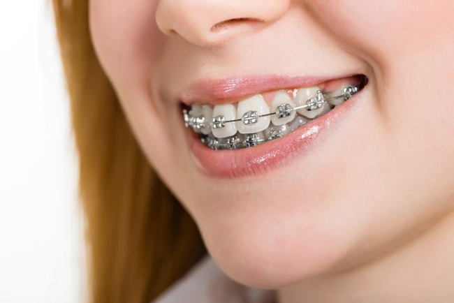 Niềng răng kim loại là gì? Quy trình và phân loại