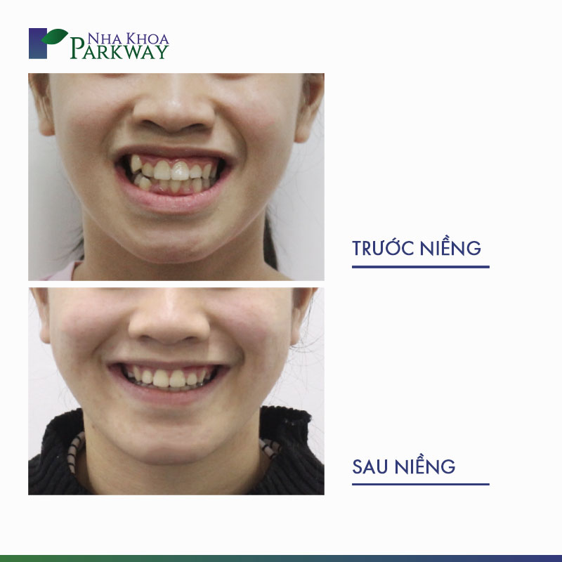 Hình ảnh niềng răng: Hình ảnh niềng răng sẽ giúp bạn hình dung rõ hơn về quy trình niềng răng và kết quả đẹp mắt sau khi hoàn thành. Với những bức ảnh trước sau của các bệnh nhân đã niềng răng, bạn sẽ không ngần ngại chọn lựa đúng cách thức để có một hàm răng hoàn hảo.