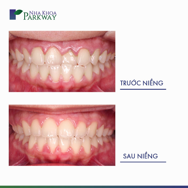 hàm răng trước và sau khi niềng răng móm