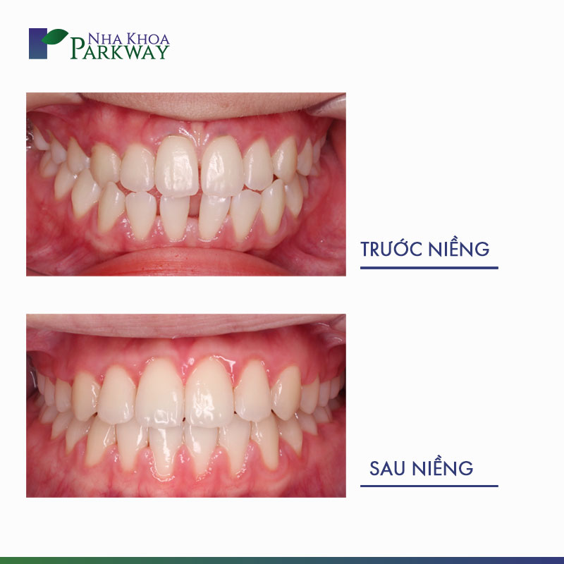 hàm răng trước và sau khi niềng răng thưa