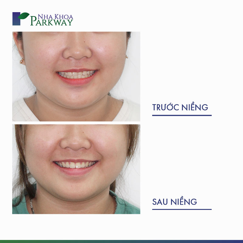 Khuôn mặt trước và sau khi niềng răng món