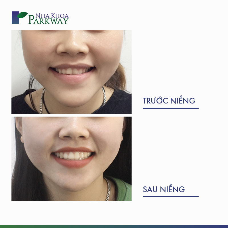Khuôn mặt trước và sau khi niềng răng móm