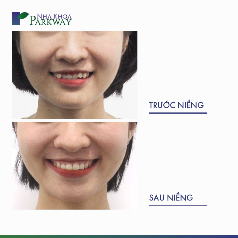 Khuôn mặt trước và sau khi niềng răng móm