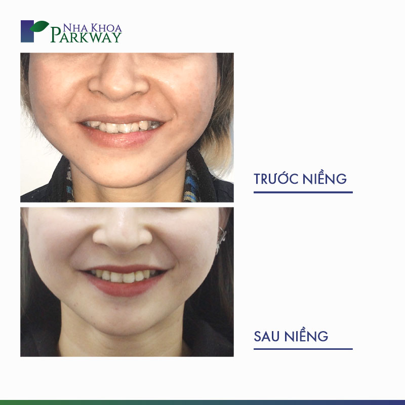 Khuôn mặt trước và sau khi niềng răng