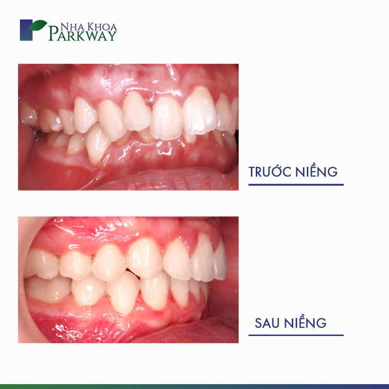 hàm răng trước và sau khi niềng