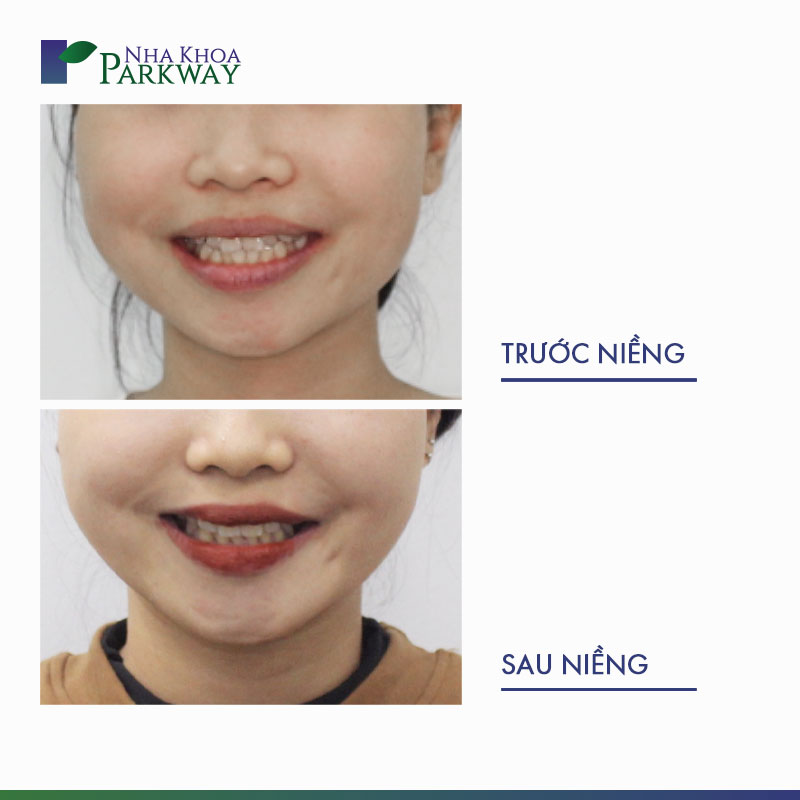 Khuôn mặt trước và sau khi niềng răng