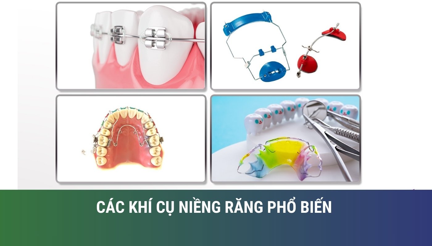 Các khí cụ niềng răng chỉnh nha mà bạn cần biết