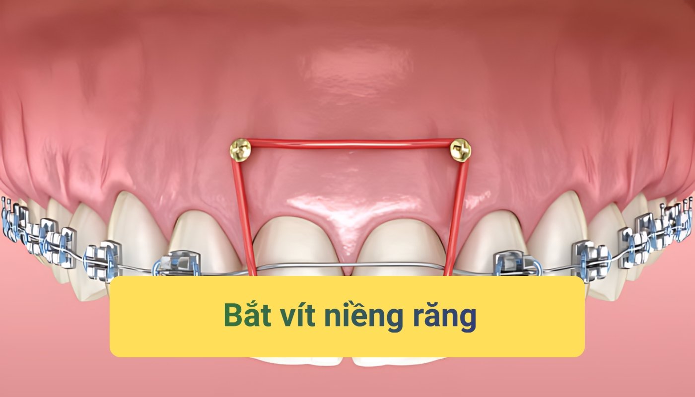 Bắt vít niềng răng