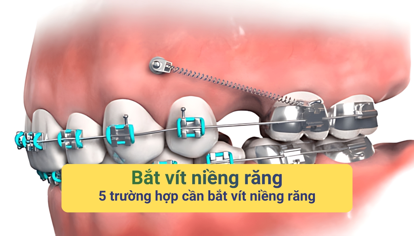 Bắt vít niềng răng và 5 trường hợp cần bắt vít