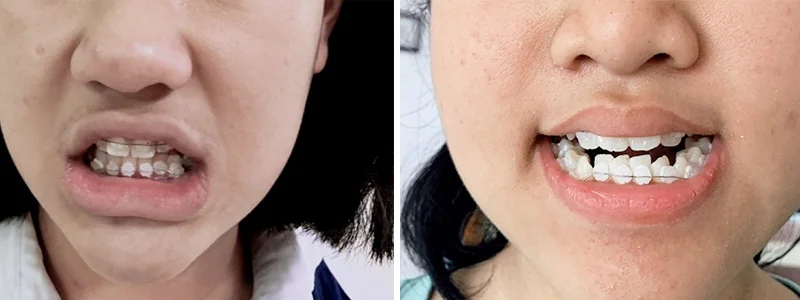 lưu ý khi niềng răng mắc cài sứ