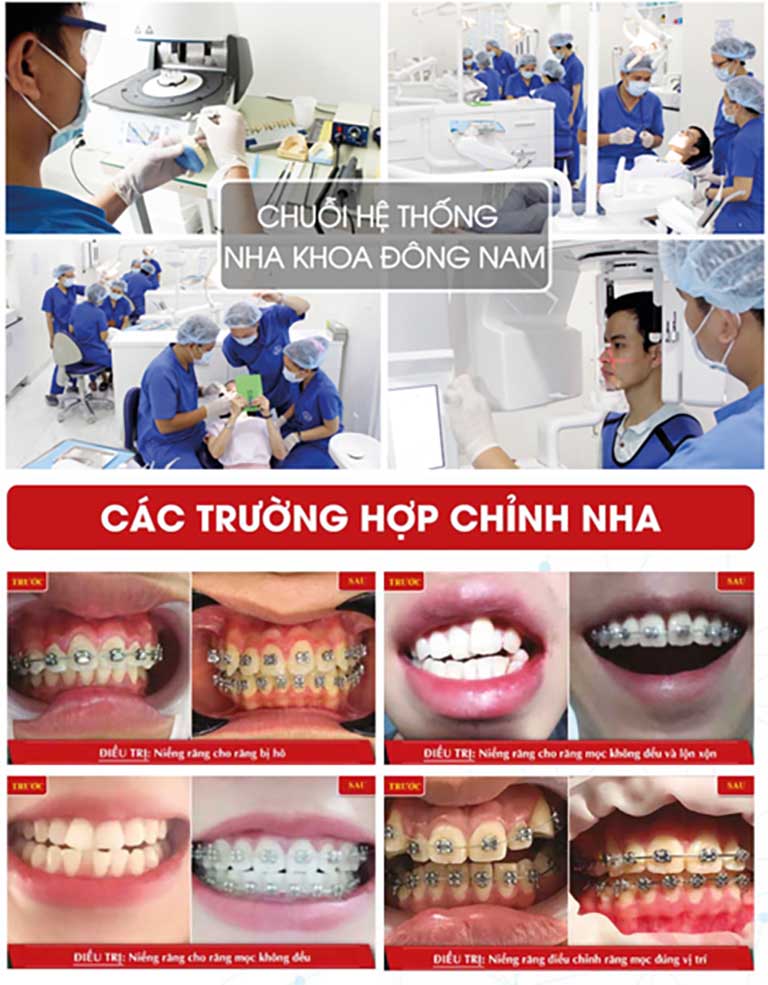 Địa chỉ niềng răng tốt ở tpHCM - Nha khoa Đông Nam